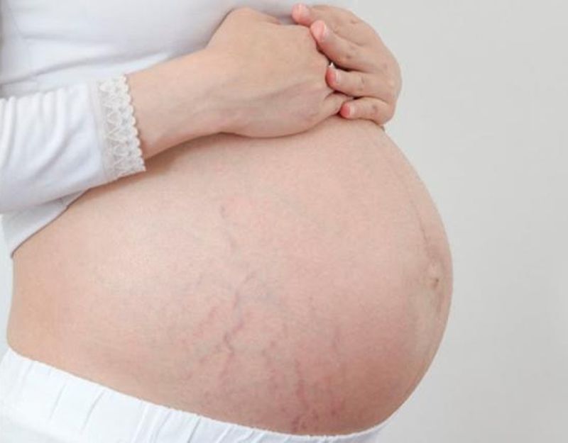 تشققات البطن بعد الحمل